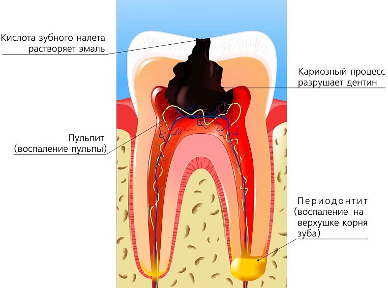 Лечение пульпита молочных зубов в Жуковском